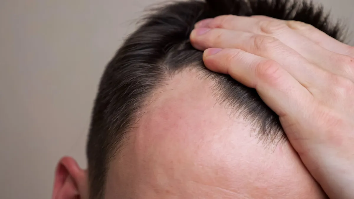 receding hairline treatment
